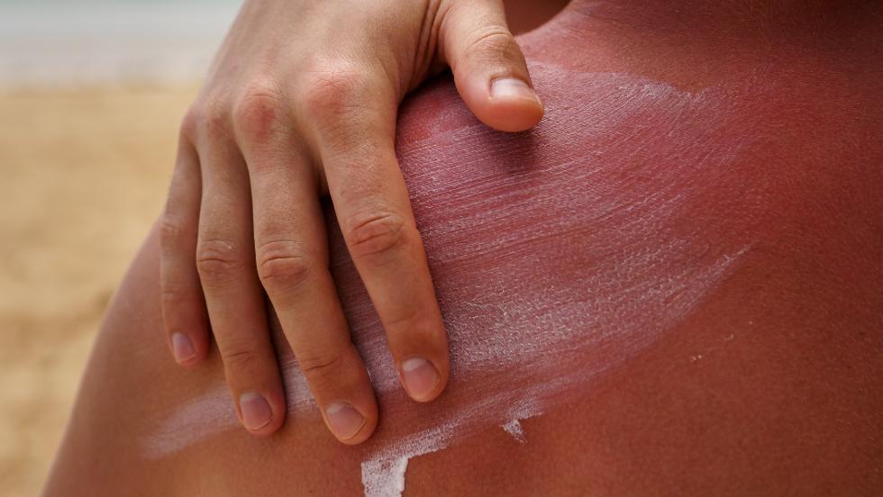 Figyelem: már most extrém erős az UV-sugárzás Figyelem: már most extrém erős az UV-sugárzás